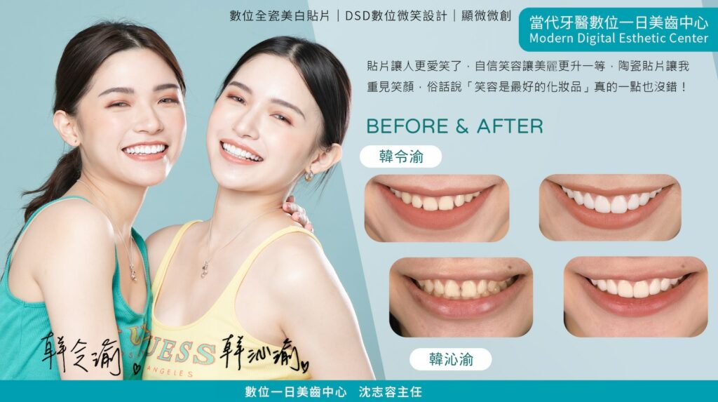 陶瓷貼片-牙齒整形-數位微笑設計-推薦案例-桃園-當代牙醫-青埔-沈志容醫師
