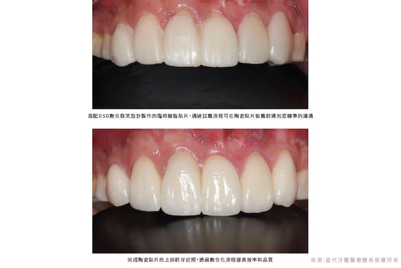 植牙-舒眠麻醉-舒眠植牙-DSD微笑設計-陶瓷貼片-葉立維醫師-當代青埔牙醫-cnews新聞網