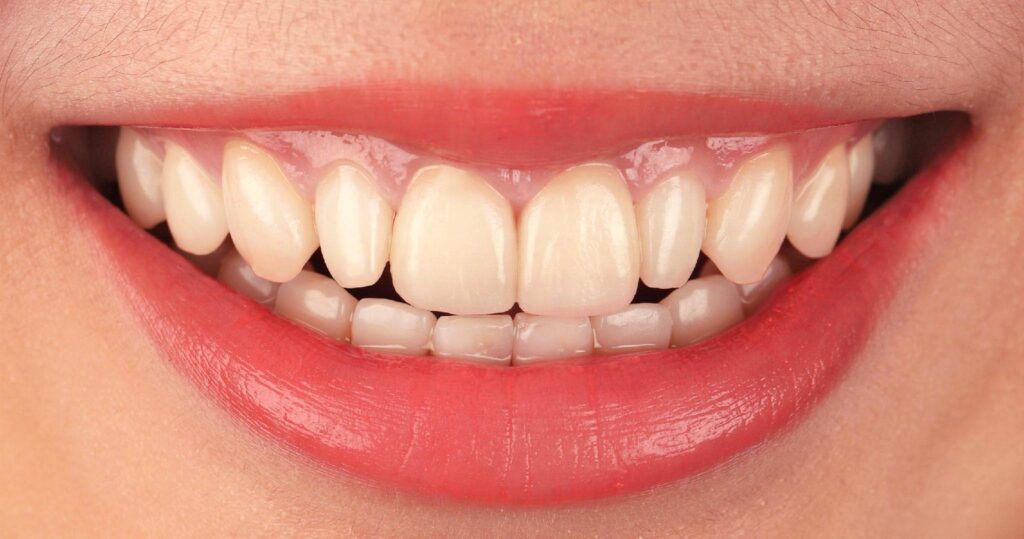 陶瓷貼片-全瓷冠-牙齒矯正-牙齒美白-沈志容醫師-當代青埔牙醫-桃園
