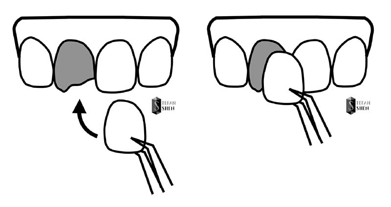 陶瓷貼片-全瓷冠-陶瓷貼片治療示意圖-沈志容醫師-當代青埔牙醫-桃園