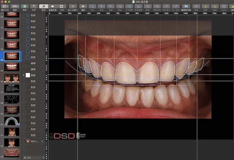 陶瓷貼片-牙齒美白貼片-DSD微笑設計分析報告示意圖-沈志容醫師-當代青埔牙醫-桃園