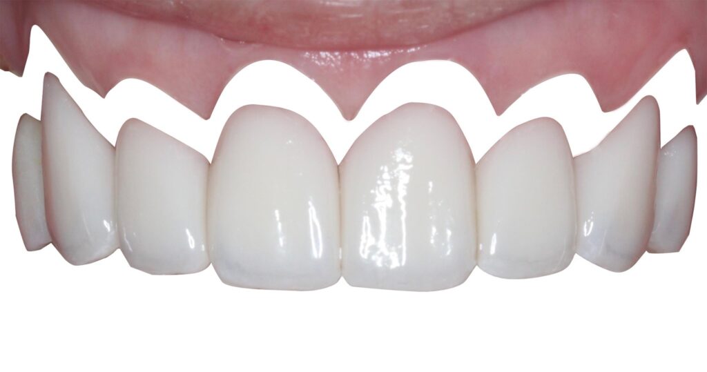 水雷射牙齦-陶瓷貼片-牙齦萎縮-推薦-桃園-當代青埔牙醫-葉立維醫師