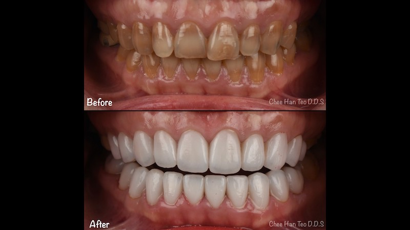 四環黴素造成牙齒染色暗黃伴隨條紋狀色斑，陶瓷貼片治療後美白齒色並美化微笑曲線