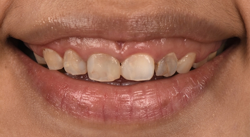 笑齦-笑露牙齦-牙冠增長術-陶瓷貼片-術前上排門牙-張志漢醫師-當代青埔牙醫-桃園