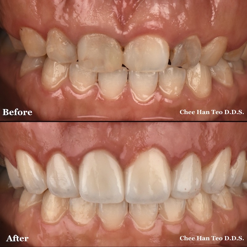 笑齦-笑露牙齦-牙冠增長術-陶瓷貼片前後微笑曲線比較-張志漢醫師-當代青埔牙醫-桃園