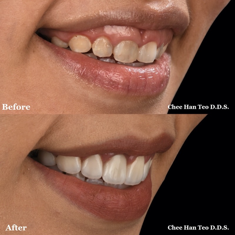笑齦-笑露牙齦-牙冠增長術-陶瓷貼片前後笑容外觀比較-張志漢醫師-當代青埔牙醫-桃園
