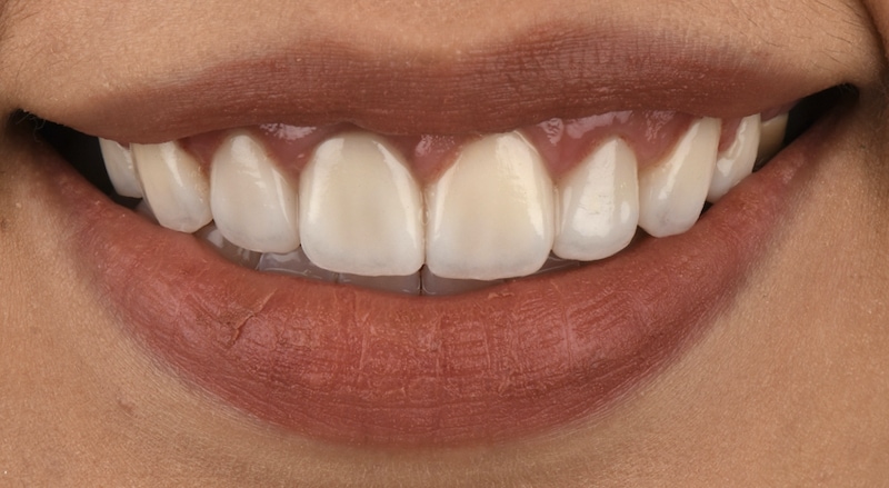 笑齦-雷射牙齦-牙冠增長術-DSD數位微笑設計-上排門牙模擬-張志漢醫師-當代青埔牙醫-桃園