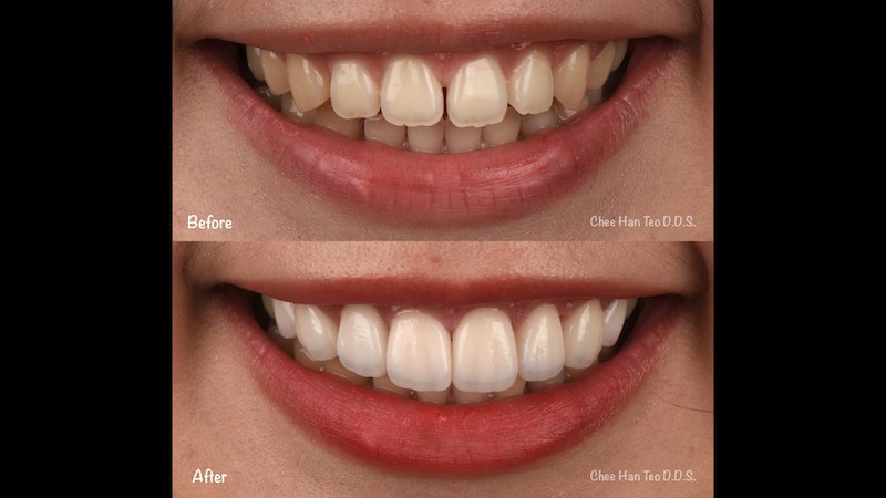 門牙牙縫大用陶瓷貼片關牙縫恢復門牙美觀，並改善牙齒顏色和比例讓笑容更完美