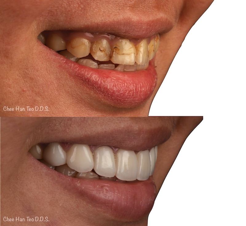 門牙蛀牙補牙在牙齒上留下黃褐色痕跡，陶瓷貼片修復後牙齒外表亮白且不易染色