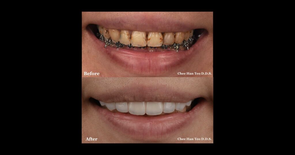 牙齒矯正-牙齒黃-牙縫大-黑三角-陶瓷貼片-推薦-桃園-當代青埔牙醫-張志漢醫師