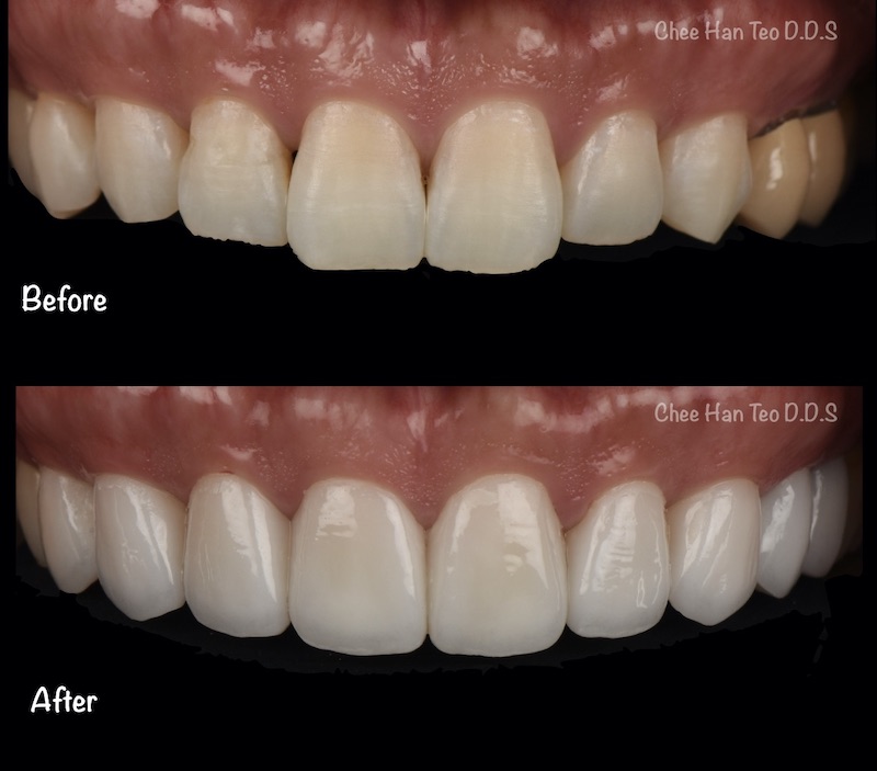 矯正後牙縫變大-黑三角-陶瓷貼片前後上排牙齒正面比較-張志漢醫師-當代青埔牙醫-桃園