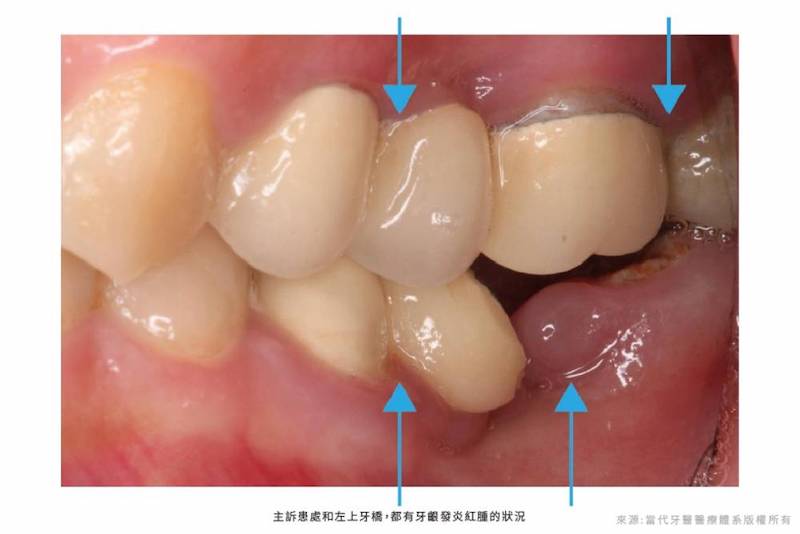 輕微牙周病-植牙前-假牙不密合-牙齦發炎紅腫-葉立維醫師-當代青埔牙醫-cnews新聞網