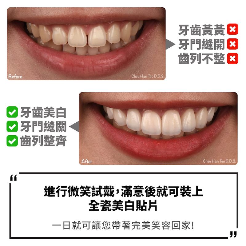 門牙牙縫大用陶瓷貼片改善前後的比較，一日關閉牙縫、美白牙齒