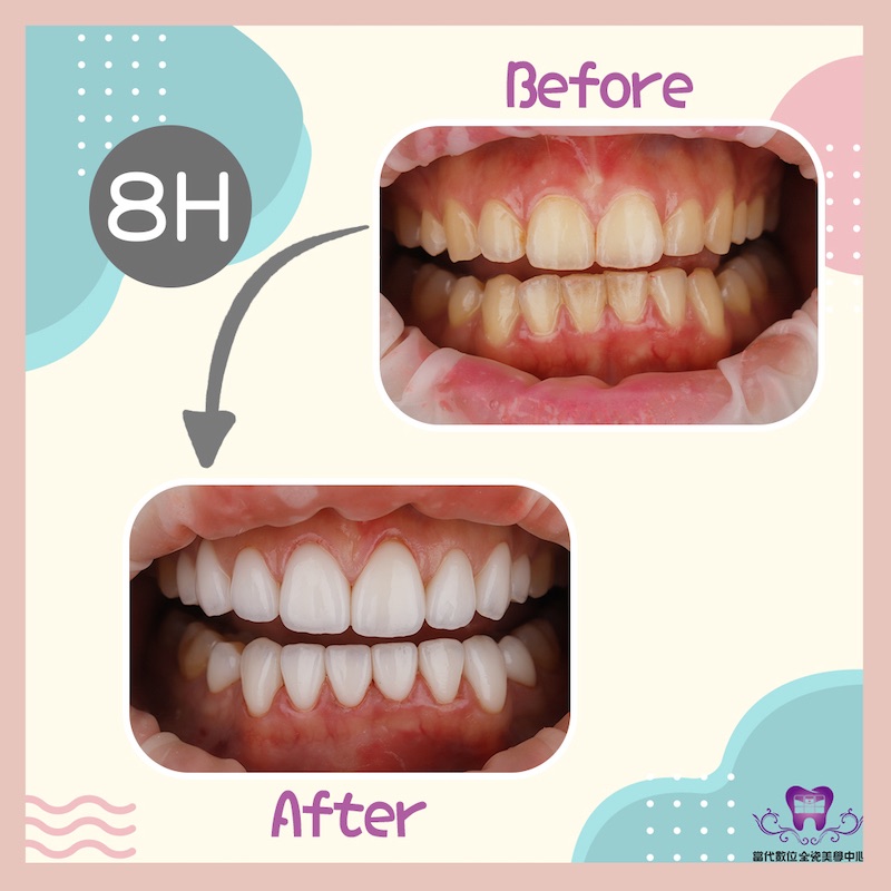 水雷射牙齦整形搭配上下排各8顆陶瓷貼片，療程前後的微笑曲線對比