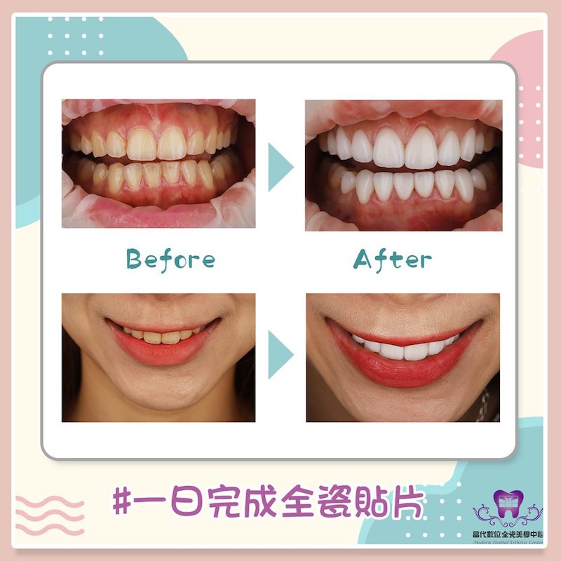 陶瓷貼片牙齒美容前後比較，牙齒變白、笑容也更飽滿
