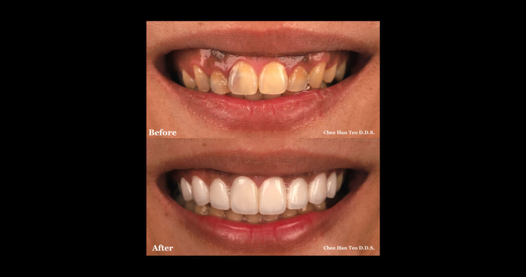 水雷射-牙齦美容-牙齦整形-陶瓷貼片-推薦-桃園-當代青埔牙醫-張志漢醫師