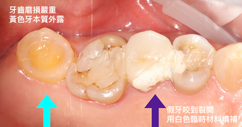 寇乃馨治療前的後牙狀況，有牙齒磨損嚴重導致牙本質外露、假牙裂開、填補多次及破損等情形