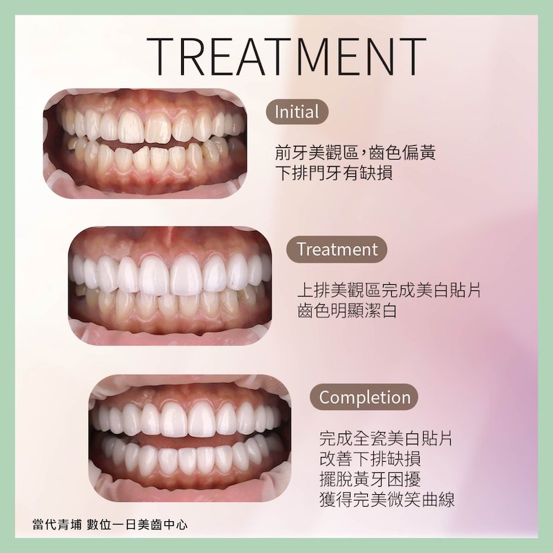 藝人嘻小瓜在陶瓷貼片治療前後的牙齒外觀對比：治療前有門牙缺角、牙齒偏黃等問題；治療後修復下排門牙缺角、齒色明顯變白並有完美微笑曲線