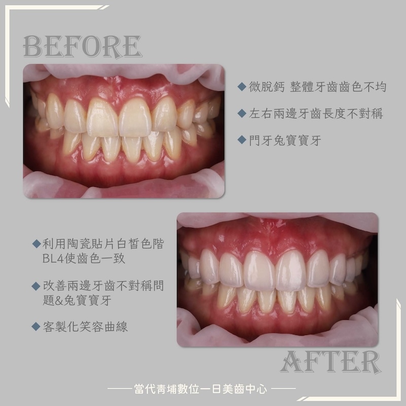 樂天女孩黃禹菡陶瓷貼片療程前後對比，治療前兔寶寶門牙、左右牙長度不對稱、牙色不均；治療後牙色提升至BL4白皙色階，微笑曲線更對稱協調