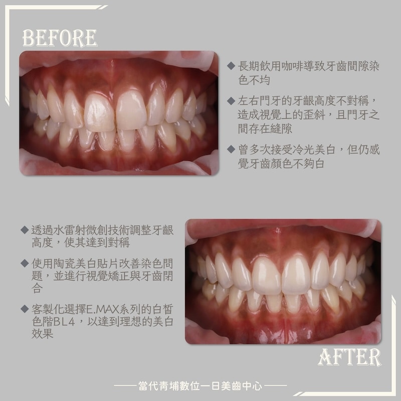 阿布舞牙齒染色與牙齦高低不對稱,經水雷射牙齦調整與陶瓷貼片改善前後對比