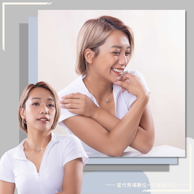 阿布舞完成陶瓷貼片與水雷射牙齦調整後,呈現自然亮白笑容